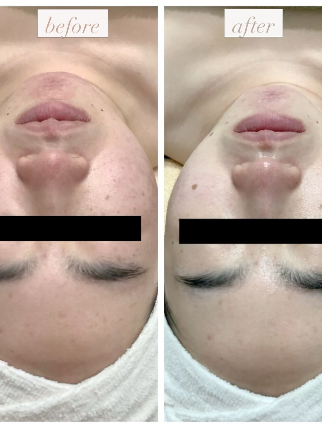 ✨ BBL光フェイシャルでワンランク上の美肌ケア ✨