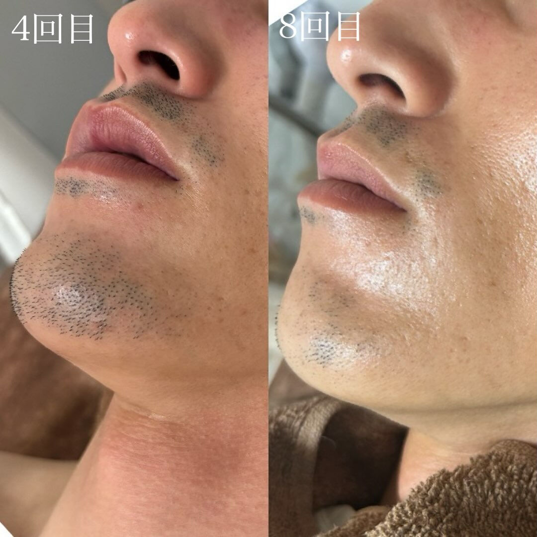 ハイブリッドヒゲ脱毛　30代のお客様の変化です🙌🏻