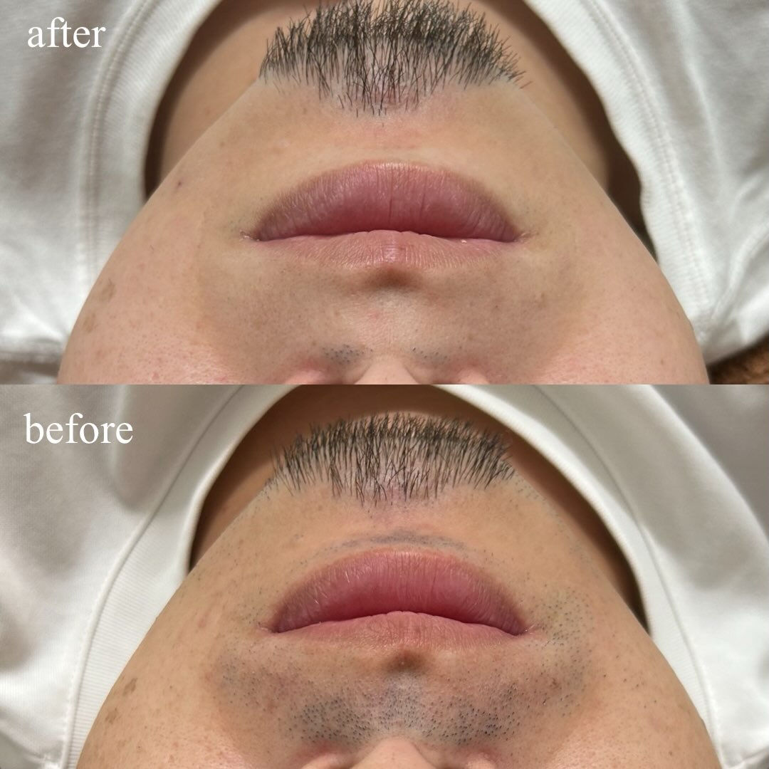 【ハイブリッドヒゲ脱毛 Before → After】