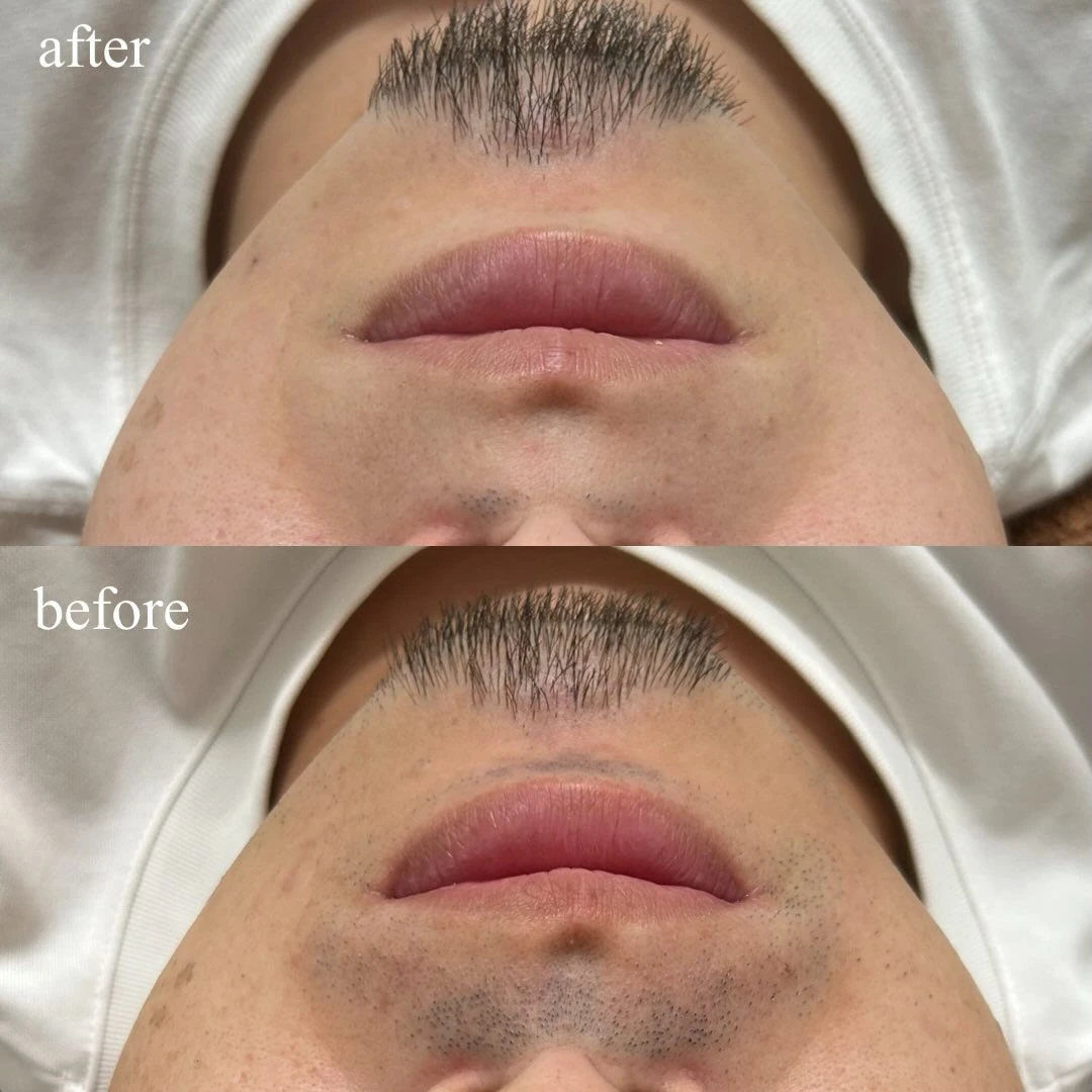 【ハイブリッドヒゲ脱毛 Before → After】