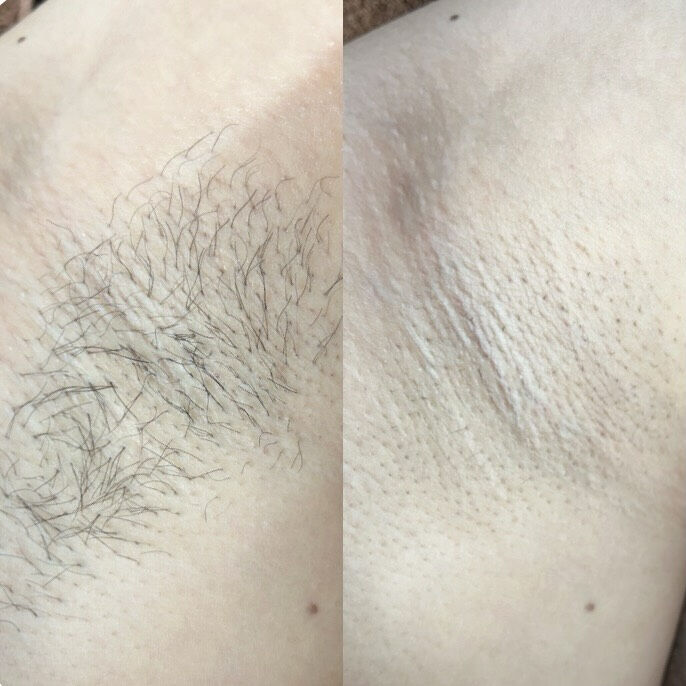 【メンズワキ脱毛 Before → After✨】