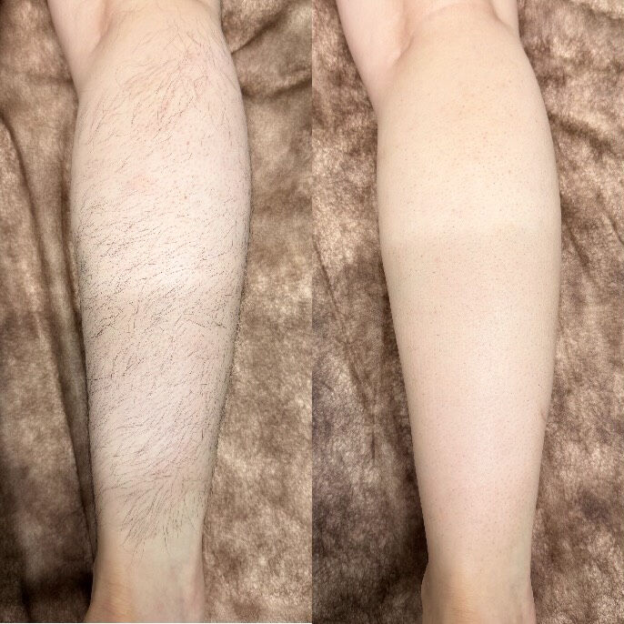 ✨メンズ脚脱毛 Before → After✨