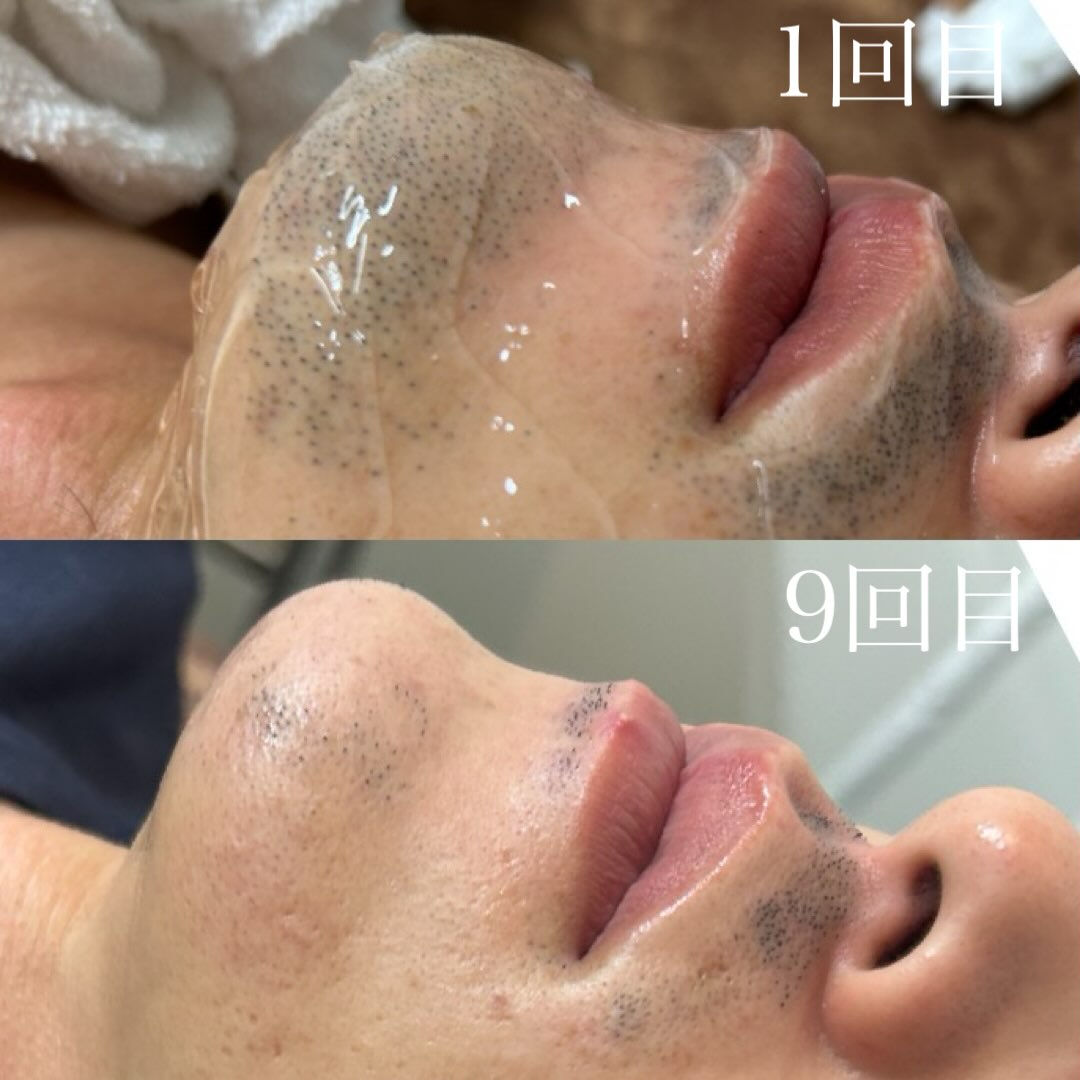 【ハイブリッドヒゲ脱毛 Before → After ✨】