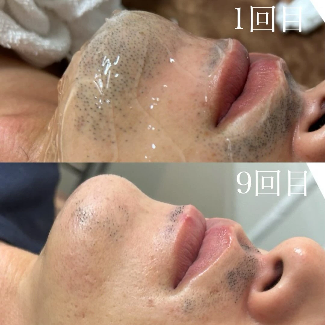 【ハイブリッドヒゲ脱毛 Before → After ✨】