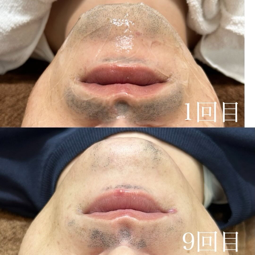 【ハイブリッドヒゲ脱毛 Before → After ✨】